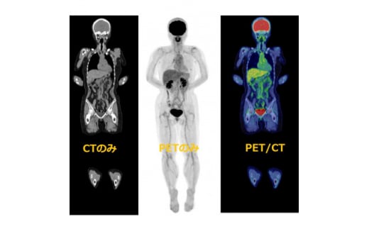 PET-CT総合がん検診(脳検査付)【1303247】